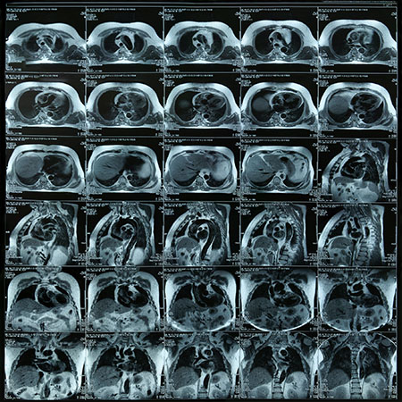 МРТ - передовой способ диагностики заболеваний позвоночника