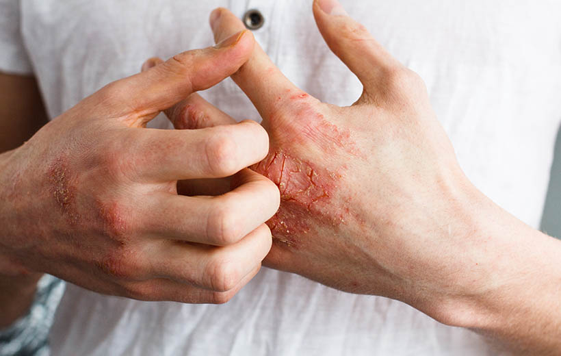 Почему кожа на руках становится сухой: основные причины и способы устранения