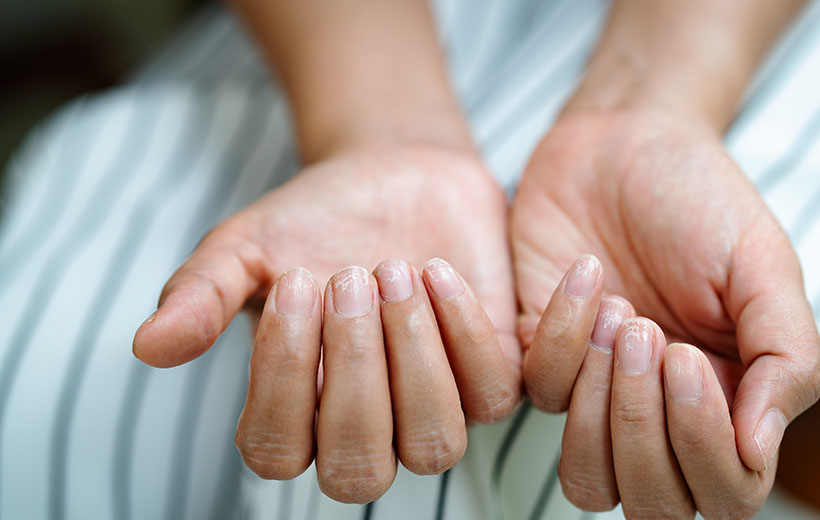 Слоятся ногти - причины появления, при каких заболеваниях возникает, диагностика и способы лечения