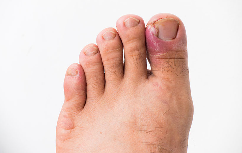 Как лечить нарыв под ногтем на руке или ноге?